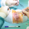 Medical professionals performing surgical procedure with surgical instruments